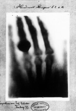 X-ray of the left hand of Anna Bertha Ludwig